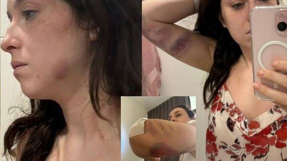 Ms Towey has shared images of her injuries.