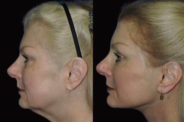 Female facelift patient, side view. Improved lower face definition and youthful appearance.