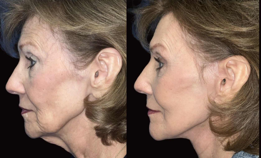 Side view before and after photos of female patient, showcasing facelift results in Shreveport.