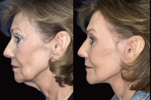 Side view before and after photos of female patient, showcasing facelift results in Shreveport.