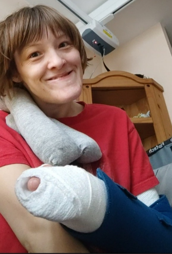 Ailsa smiling at the camera showing her arm in the cast and sling. She is wearing a red T-shirt. She is sitting above the camera, and the tip of her finger is poking out of the cast. Wooden corner unit and ceiling hoist are in the background.