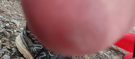 Spasticity and Splints (Part 2)