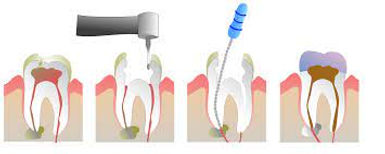 endodoncia.jpg