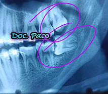 odontectomia de muelas del juicio.jpg