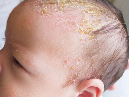 Understanding Cradle Cap: Symptoms, Causes, and Effective Treatment for Your Baby
