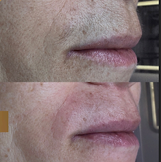 Epilação com linha