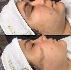 Dermaplaning em Hortolandia