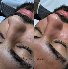 Limpeza de pele em Hortolândia