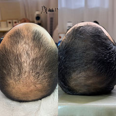 Reconstrução capilar