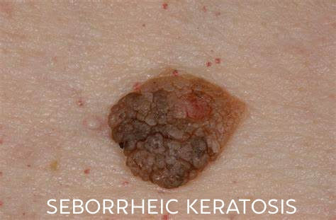 Thumbnail:  LUMENA PICO PIGMENT  LASER 