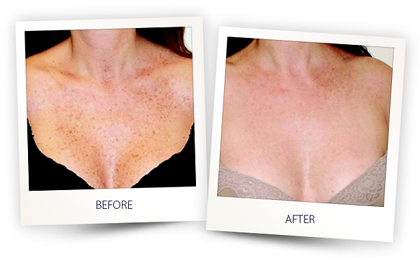 sun-spots-treatment