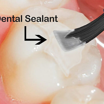 Sealants