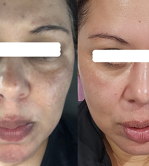 Depigmentation, skin peel, cosmelan, melano out, pigmentation, pigmentation treatment, depigmentation, freckles, sun damage, sun spots, sun induced, dark spots, dark patches, bright skin, white skin