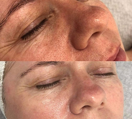 Microhydralift, hydra facial, hydro facial, hydrating facial, glow facial, deep cleanse facial, pick me up facial, party facial, brighter skin, hydrate skin, skin lift, blackhead removal, extractions, smooth skin