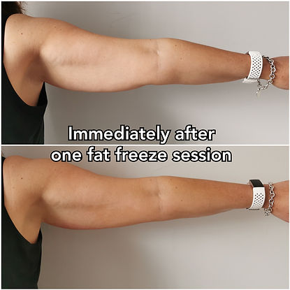kill fat cells, fat cell dies, Fat freeze, fat freezing, weight loss, cm loss, inch loss, stomach fat reduction, fat reduction, stomach slim, freezing fat, lose fat.