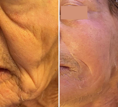 Microhydralift, hydra facial, hydro facial, hydrating facial, glow facial, deep cleanse facial, pick me up facial, party facial, brighter skin, hydrate skin, skin lift, blackhead removal, extractions, smooth skin, mature skin