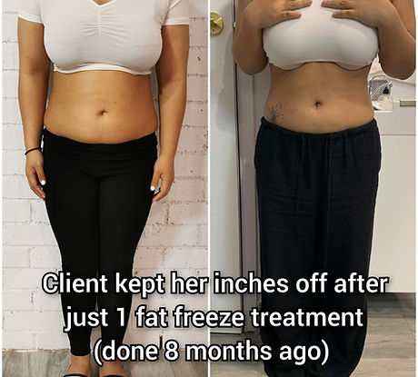 kill fat cells, fat cell dies, Fat freeze, fat freezing, weight loss, cm loss, inch loss, stomach fat reduction, fat reduction, stomach slim, freezing fat, lose fat.