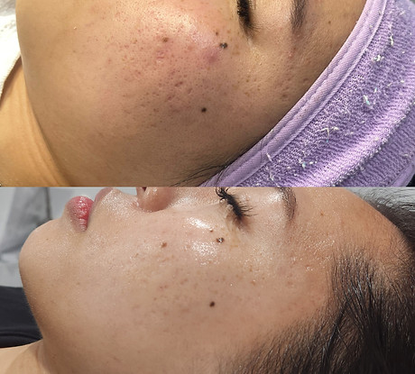 Microhydralift, hydra facial, hydro facial, deep cleanse, cleanse facial, extractions, oil control, hydrating facial