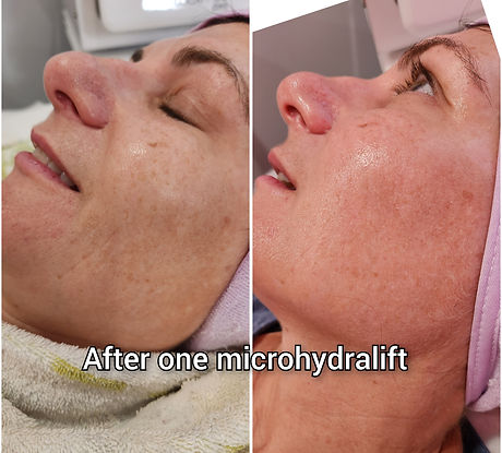 Microhydralift, hydra facial, hydro facial, hydrating facial, glow facial, deep cleanse facial, pick me up facial, party facial, brighter skin, hydrate skin, skin lift, blackhead removal, extractions, smooth skin