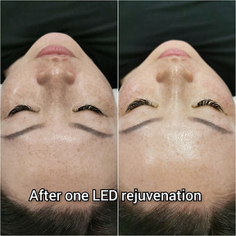 LED light therapy, LED facial, light facial, back pain, muscle pain, skin rejuvenation, facials, psoriasis, eczema, dermatitis, acne, increase collagen, skin concerns, skin conditions, skin cuts, skin burns.