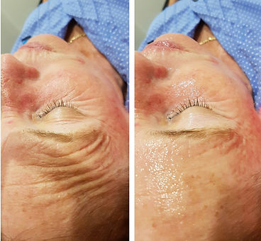 Oxygen facial, oxygen therapy, hydrating facial, hydrate skin, plump skin