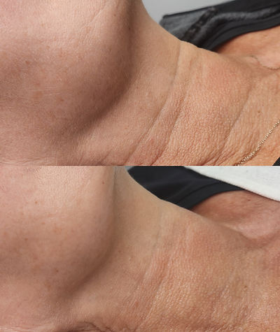 neck rejuventation, neck firming, neck lift, CPL, cpl skin rejuvenation,skin rejuvenation, laser, laser treatment, laser facial, laser skin, laser skin rejuventation, laser, pigmentation, sun spots, wrinkles, fine lines, collagen, collagen induction, increase collagen.