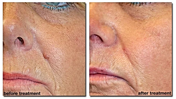 Sebaceous Hyperplasia Removal Revive Skin Aesthetics