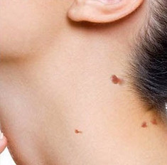 SKIN TAG REMOVAL FAQS
