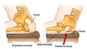 Sitting Posture effects on Coccyx