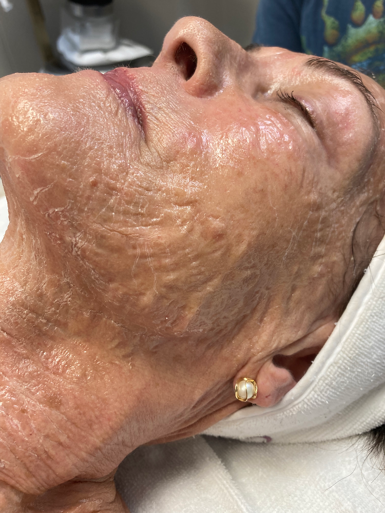 Beyond Botox All About the Beyond Botox Facial