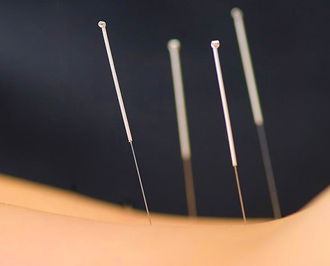 venice acupuncture, chinese medicine, functional neurology, electro-acupuncture, tui-na