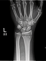 hand wrist surgery kingston