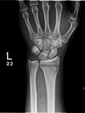 hand wrist surgery kingston
