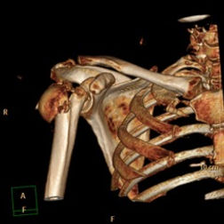 shoulder surgery hemiarthroplasty total shoulder replacement open stabilisation