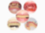 Implant retained bridge