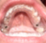 Implant Surgery