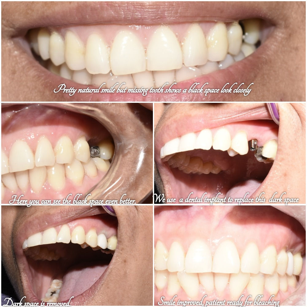 Eliminating black spaces between teeth.