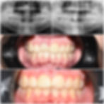 Cracked front tooth