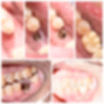 Implant crown to replace missing tooth