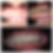Severegrinding.png