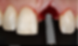 Single Dental Implant
