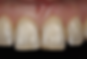 Implant with temporary restoration