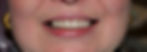 Veneers After