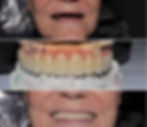 Implant Bridge