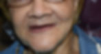 Denture before