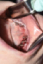 Implant lower jaw