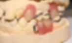 Partial Dentures