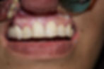 Veneers Before