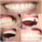 Dental Implant to replace black spaces