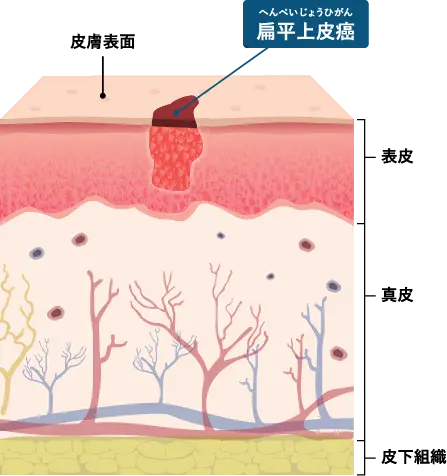 皮膚の扁平上皮癌